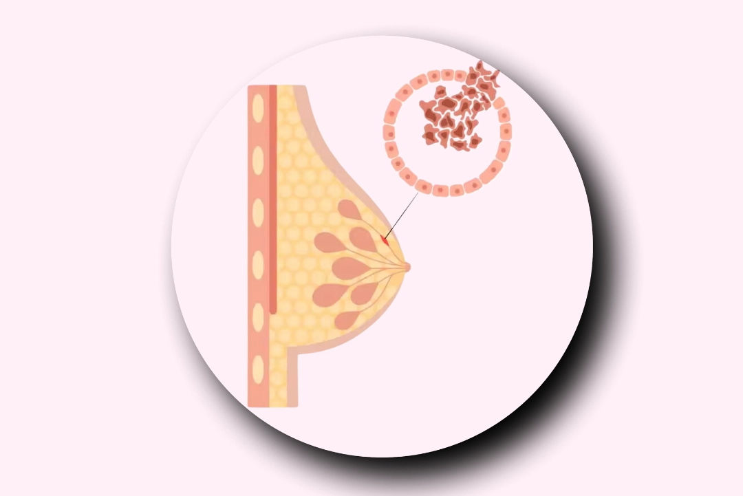 Ductal Carcinoma In Situ (DCIS)