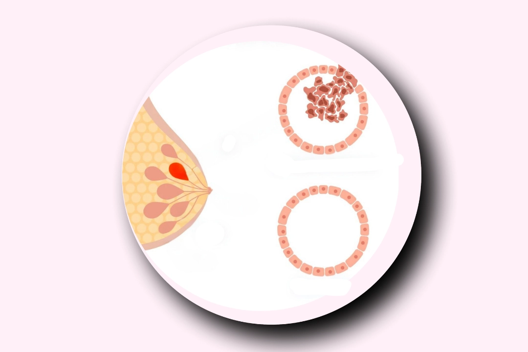 Invasive Lobular Carcinoma (ILC)