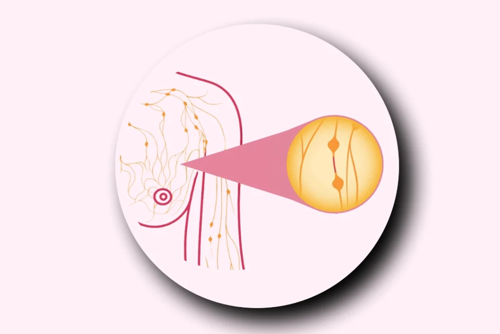 Inflammatory Breast Caearn morencer (IBC)